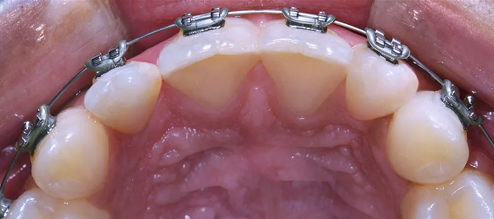 Case 03: After