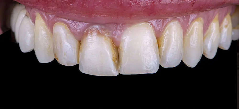 Case 14: Before