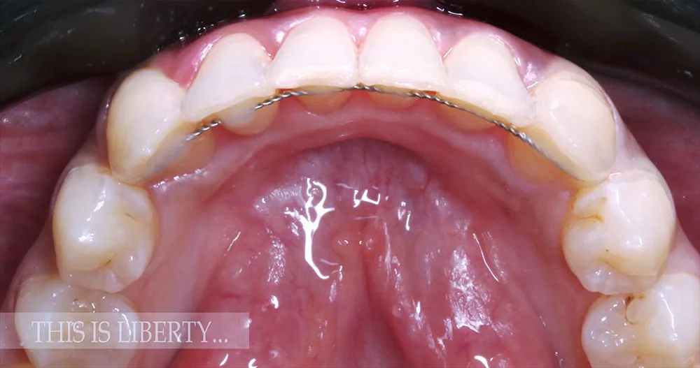 Case 29: After