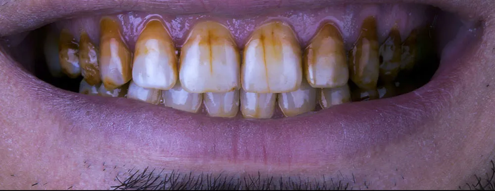 Case 33: Before