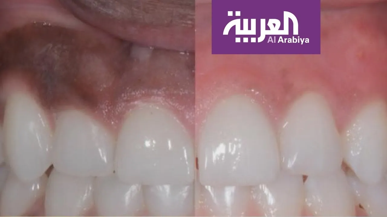 Al Arabiya: Gum lightening with a dental laser